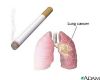 ارتباط انکار ناپذیر سیگار و سرطان ریه